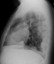 Posterior- anterior  and lateral chest radiograph demonstrates a left anterior mediastinal mass without calcification or cavitation.  The nodular left pleural thickening along the anterior, posterior and diaphragmatic pleural surfaces is suspicious for metastases rather than loculated pleural fluid collections.  Note the well-circumscribed margins of the pleural lesions and the obtuse angles with the chest wall consistent with pleural/extrapleural location.  In contrast, disease in the lungs may have either well-circumscribed or irregular margins, be surrounded by lung, and form acute angles with the chest wall.  Due to involvement of the left pleura, the stage is IVa. 